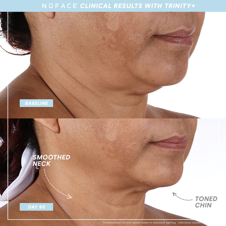 TRINITY+ and Effective Lip & Eye Attachment before after neck