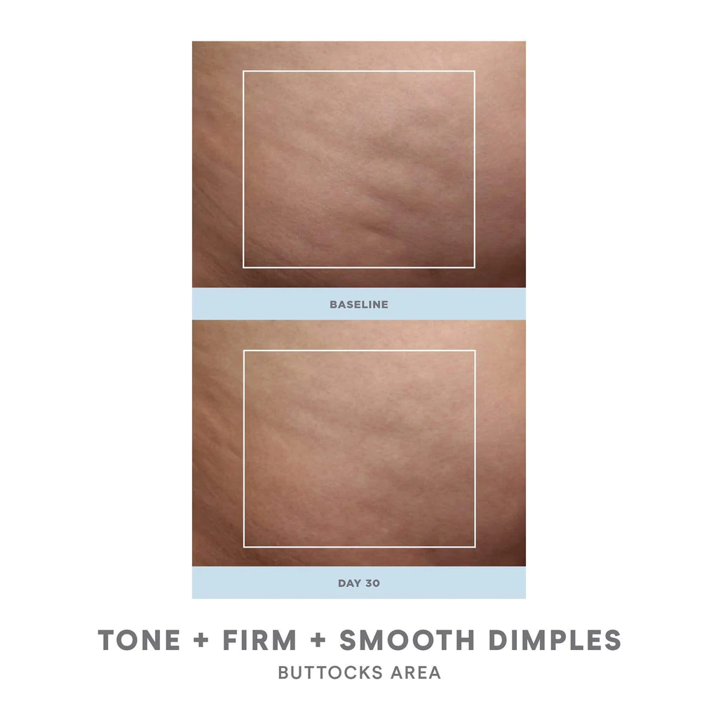 NuFACE NuBODY Body Toning Device before after butt