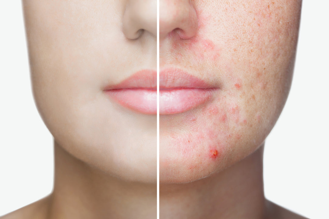 Is Your Acne Trying to Tell You Something?