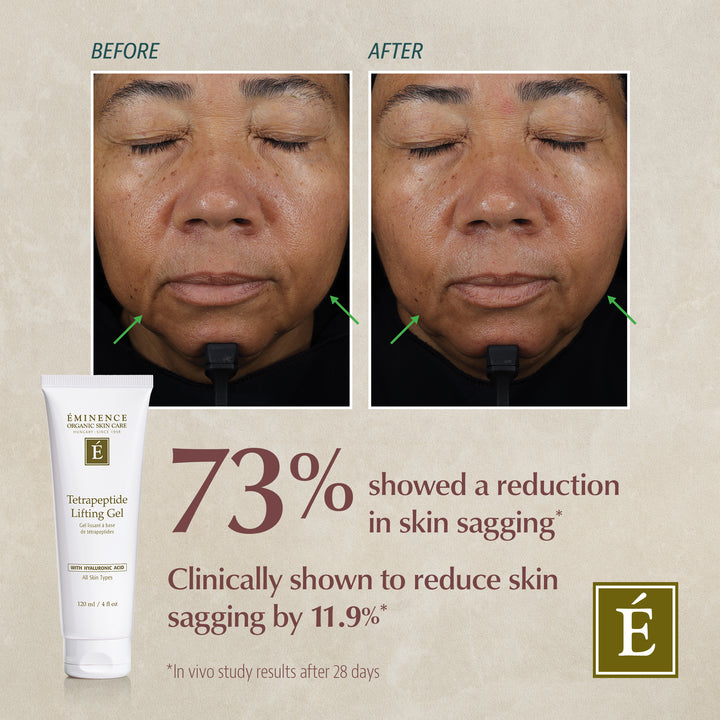 Eminence Organics Tetrapeptide Lifting Gel before and after effects on skin sagging.