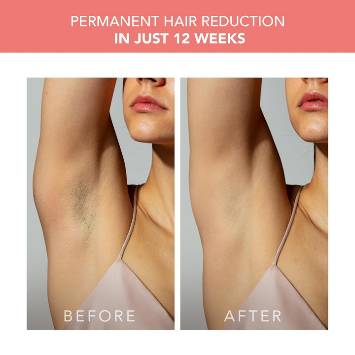 FOREO Peach 2 IPL Hair Removal Treatment Device before after