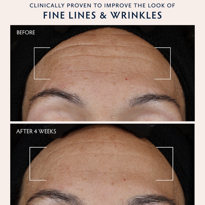 Before-and-after skincare comparison showing a person&