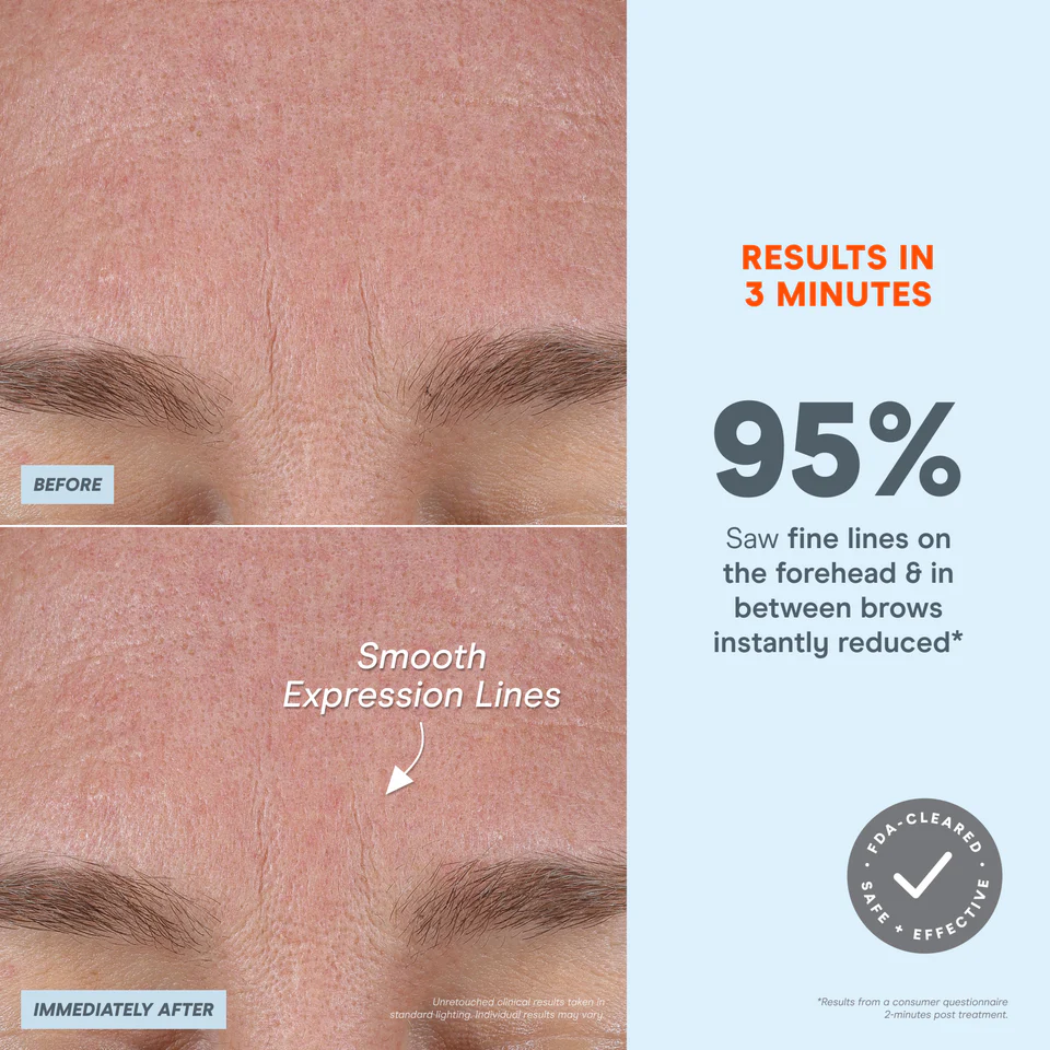 NuFACE FIX MicroWand before and after expression lines