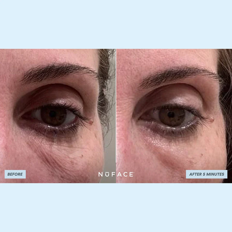 NuFACE IonPlex Hydra-Gel Power Patches before after 2