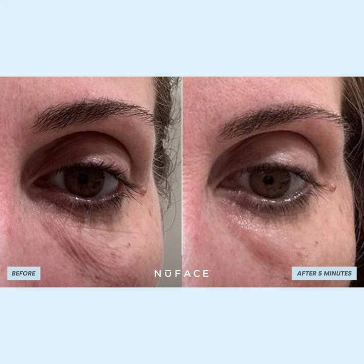 NuFACE IonPlex Hydra-Gel Power Patches before after 2