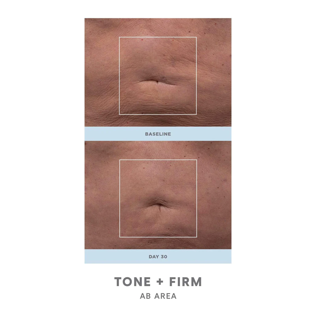 NuFACE NuBODY Body Toning Device before after